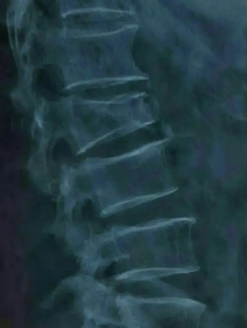 市一院骨六科完成经皮椎弓根钉棒内固定术治疗腰椎压缩性骨折一例