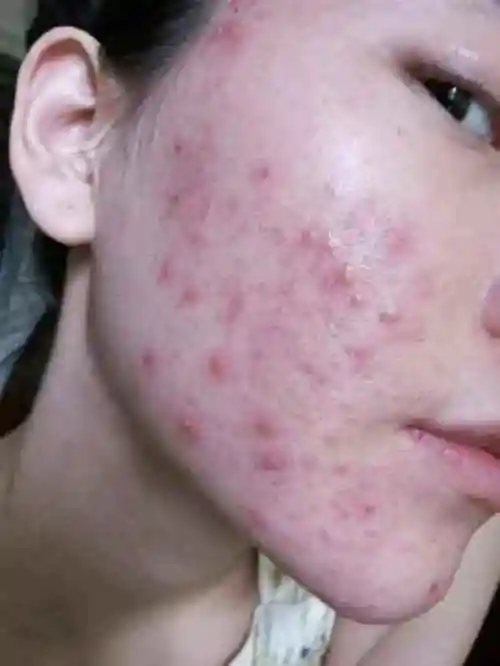 2,中学生青春痘怎么去除2  1苹果去痘印法 如果你的肌肤上有痘痘或是