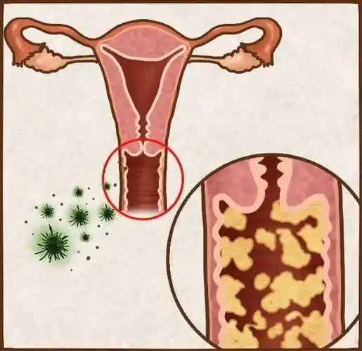 双唑泰阴道凝胶:五个远离妇科炎症小妙招_女性_细菌_肛门