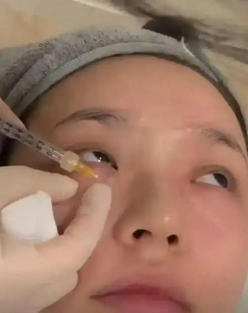 27岁林允大方分享医美过程脖子上都不放过隔着屏幕都感觉到疼