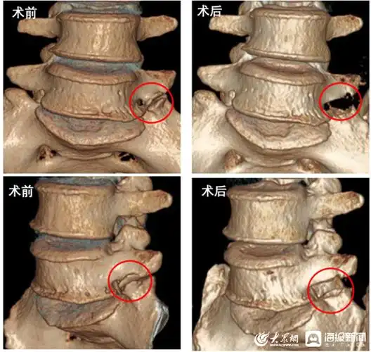 胜利油田中心医院成功开展全市首例第五腰椎横突肥大综合征脊柱内镜