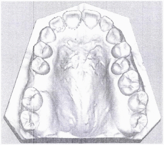 一种基于牙体长轴的质点弹簧模型的牙龈变形仿真方法与流程